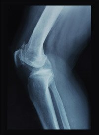 osteoarthritis treatment